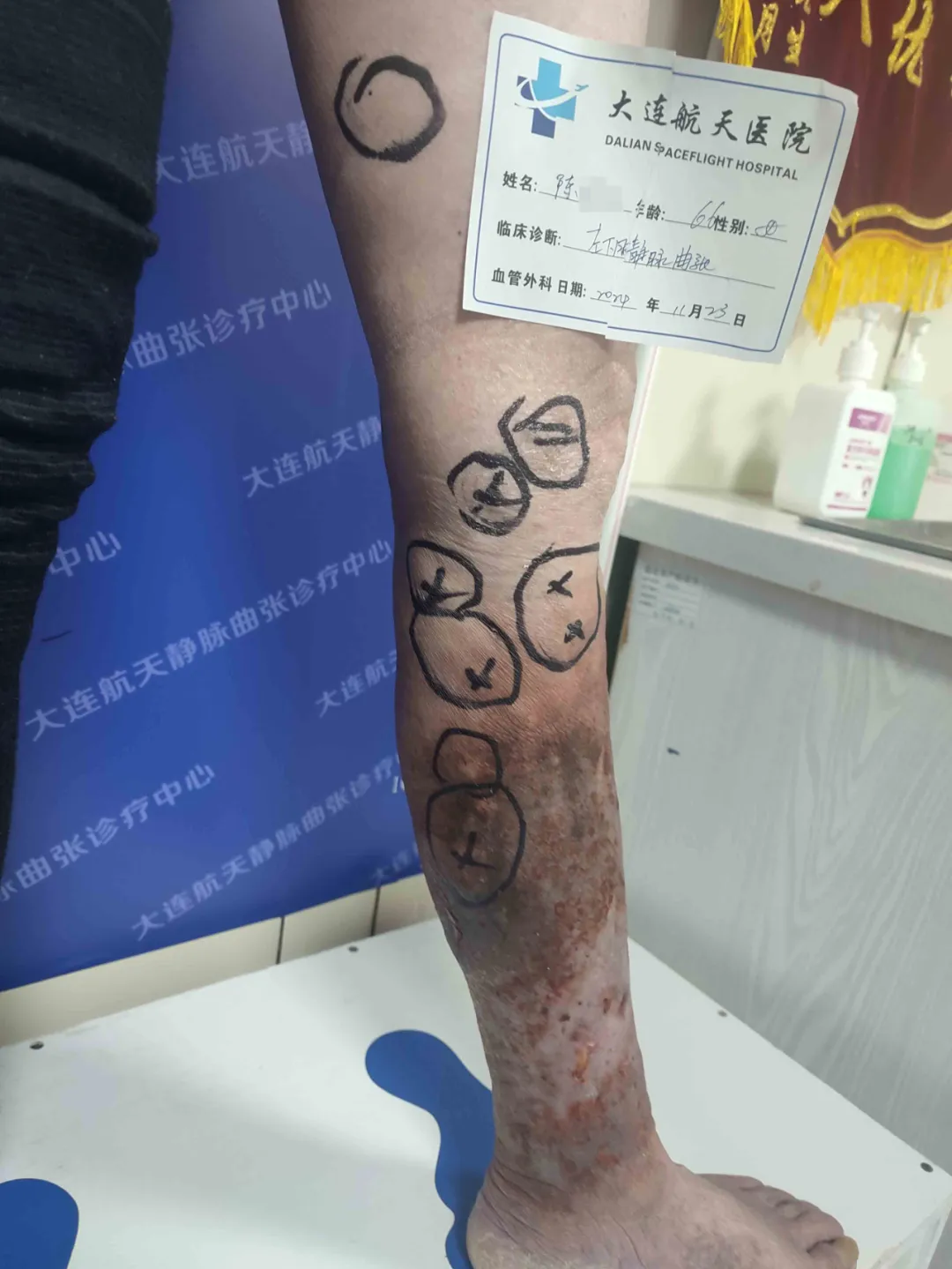 66岁慕名就医下肢静脉曲张患者,感恩赠锦旗致谢王宝珠主任团队!(图1) 66岁慕名就医下肢静脉曲张患者,感恩赠锦旗致谢王宝珠主任团队!(图1)
