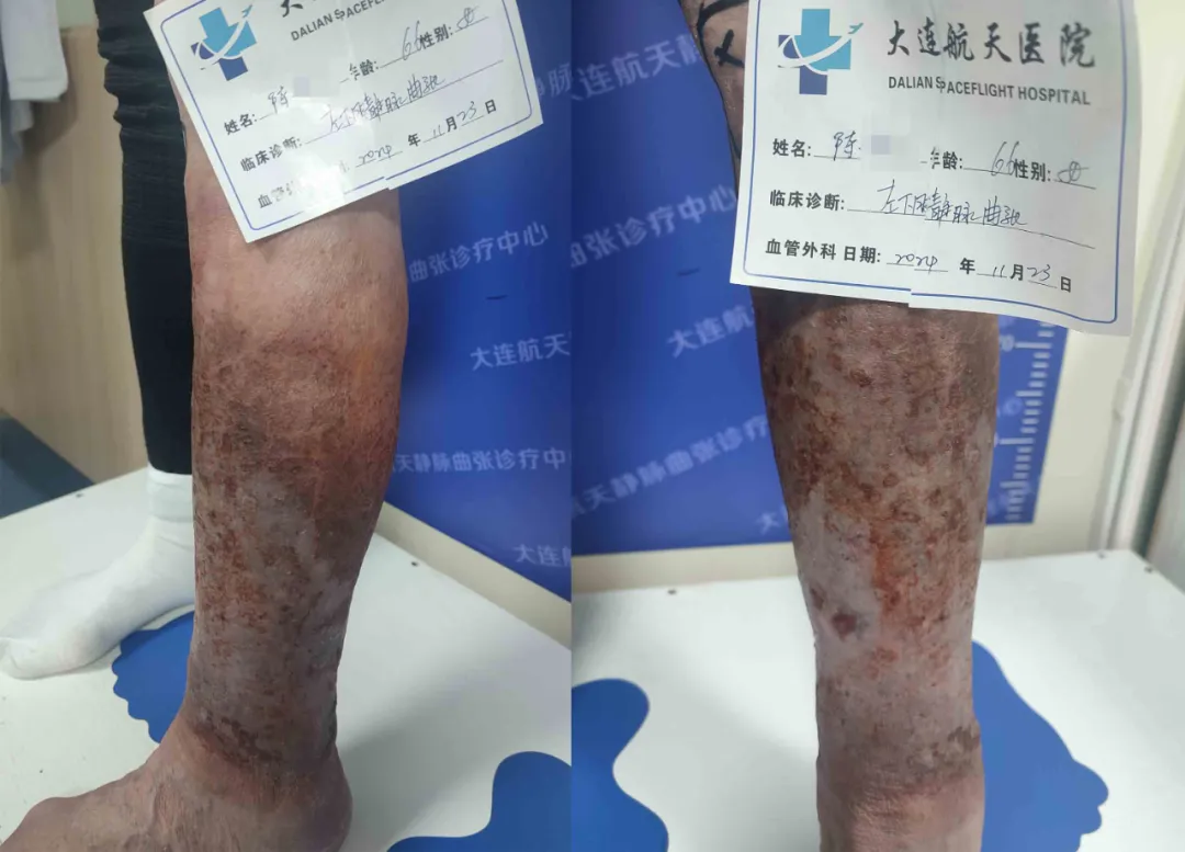 66岁慕名就医下肢静脉曲张患者,感恩赠锦旗致谢王宝珠主任团队!(图2) 66岁慕名就医下肢静脉曲张患者,感恩赠锦旗致谢王宝珠主任团队!(图2)